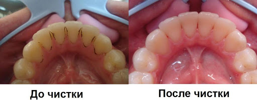 лечение зубного камня